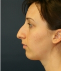 Feel Beautiful - Chin implant San Diego case 6 - Before Photo